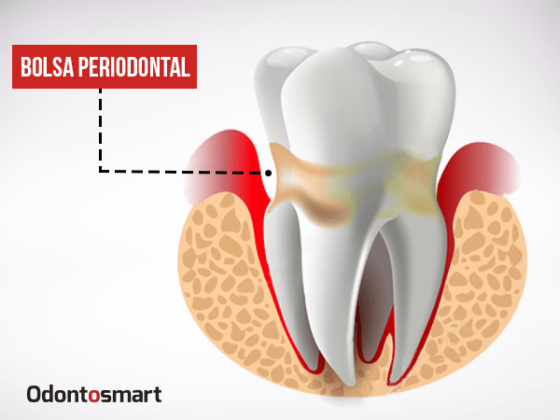 Una enfermedad de la periodoncia es la bolsa periodontal Una enfermedad de la periodoncia es la bolsa periodontal