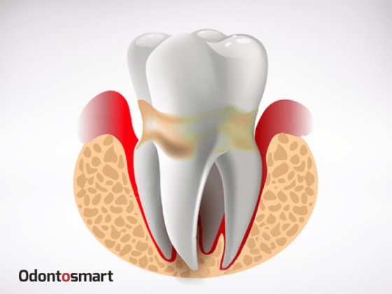 Una enfermedad de la periodoncia es la periodontitis Una enfermedad de la periodoncia es la periodontitis