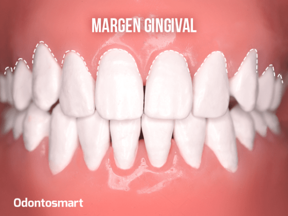 Margen gingival Margen gingival