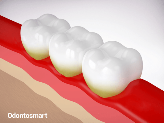 Una enfermedad de la periodoncia es la Placa bacteriana Una enfermedad de la periodoncia es la Placa bacteriana